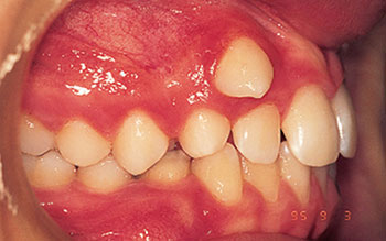 Abnormal Eruption of Teeth