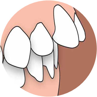 Forwardly Placed Teeth